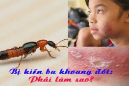 5 bước xử lý khi bị kiến ba khoang cắn để tránh để lại sẹo