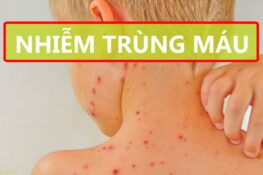 Nguyên nhân gây nhiễm trùng máu thường gặp và cách phòng ngừa an toàn
