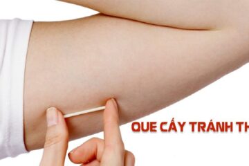 Tìm hiểu phương pháp cấy que tránh thai: Có nên thực hiện không?